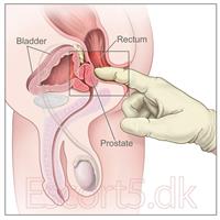 prostata massage